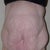 4 wk pre-op