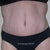 4 wk post-op