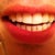 Aligner 10/20, only 5 months left to go as long as everything goes as planned. Tooth reshaping will be done last..