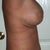 1 week post op