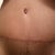 9 Weeks PO - Up close incision