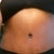 this is about 12 days post op.