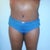 You can see the swelling on my upper torso. My garment is not tight up there at all and I can not stand the way that part look. See how shinny it is. Gpnna get that taken cared of on monday I hope