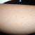 Lower leg after first laser treatment with Alexandrite 755nm laser for hair reduction/removal. One week post first treatment.
