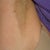 Underarm post 1 week after treatment with laser.