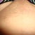 Bikini post 1 week of laser hair removal first treatment.