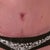 Close up of my BB and incision, healing a lot better than I thought it would!