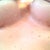 incisions healing - never liked the silicone strips so just letting them heal on their own.