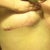 side scars - 9 months post op