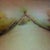Day 5 Incisions