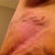 More Lipo Ouchies