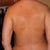 15 Days post OP