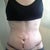 day 13 post op. still covered in sticky stuff that wont come off
