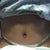 Day after my surgery