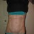 8 Months Post-Op...results look even better in person!  Vein kind of stands out with the flash!