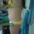 Pre-op left side.