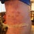 Post op day 6 it look like they used a clamp to pull my skin down with the way the bruising is