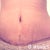 not sure if the scar is uneven from swelling, my body's alignment or the incision itself but i am just happy it is so low!