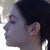 Profile 6 week post-op