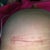 Incision as of today! Still have to keep steri strips on this one right side with having second surgery and trauma to this breast ugh! I would never do it again... My luck sucks!