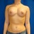 Two weeks post op