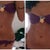 Download the app "surgeon" This is what I am hoping to achieve after the surgery!