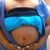 1 WEEK AFTER SURGERY