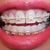 6wk: Teeth are a mess.  Spacing between front teeth, and others. Heard this is necessary for future movement. Yep that's food in my teeth. Ha.  That's what happens if you don't waterpik.