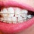 6wk: Teeth are a mess.  Heavy spacing especially on the L teeth. Heard this is necessary for future movement.