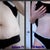 20 days PO.  Still dealing with a ton of swelling just above the scar line but so far I am pleased.