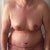 15 days post op - Front view, afternoon swelling for sure