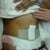 Day 1 Post Op picture