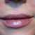 Lips & NL immediately after