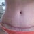 incision at 4 months po