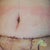 4 days post up. Loads of swelling but no flapping apron of skin! The pink on my tummy is from my compression garment. I need to start wearing something underneath it.