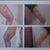 Picture on left one week post lipo- picture on right after one visit- swelling+ busing went down