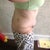 8 days post op