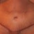 See how all the swelling is low like under the scar and in my pubic area, it is terrible it is really pushing on the incision now