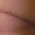 I think the incision looks good still a little glue at spots but I think that is looking OK?