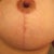 aerola scar