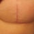 breast scar