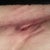 Open sore on scar