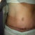 My scar at 3.5 months PO