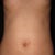 11 DAY POST-OP: Bruises are barely there!