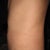 11 DAY POST-OP:: Side view.not too shabby!
