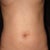 11 DAY POST-OP: Front View