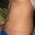 3 WEEK POST-OP: Sitting, profile...still some rolls--I hope it's just swelling and not fat rolls!