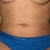 3 WEEK POST-OP: Letting it all hang out...definitely better than before surgery, but still hoping for flatter!