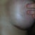 2 month post op