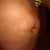 Hernia present!